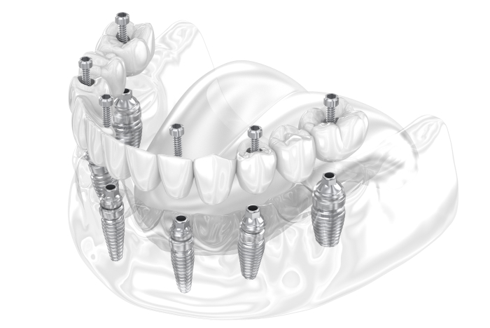 전체 임플란트